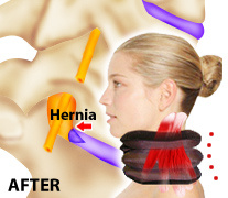 Neck Traction, Air Neck Traction, How Air Neck Traction Works, Mag 4,